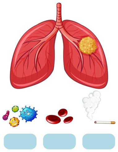 Diagramme de cancer du poumon avec virus et cigarette vecteur