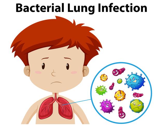 Infection pulmonaire bactérienne chez un garçon vecteur