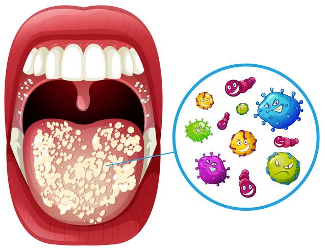 Infection par le virus de la bouche humaine vecteur