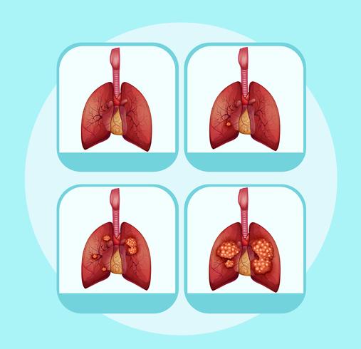 Diagramme montrant les différentes étapes du cancer du poumon vecteur