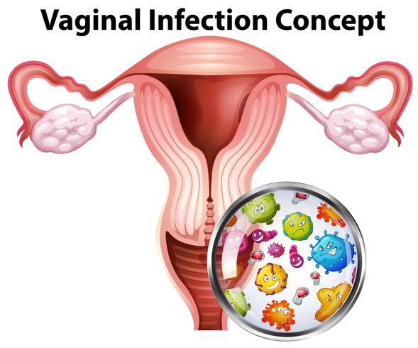 Concept bactérien d&#39;infection vaginale vecteur