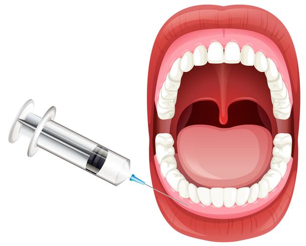 Anatomie de la bouche montrant l&#39;injection de gomme vecteur