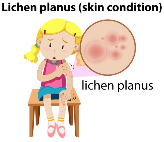 Lichen planus maginfied sur fille vecteur