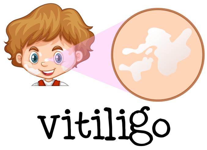 Un garçon avec du vitiligo sur le visage vecteur