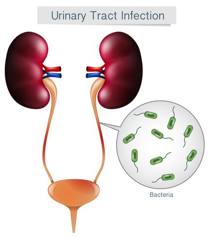 Infection des voies urinaires sur fond blanc vecteur