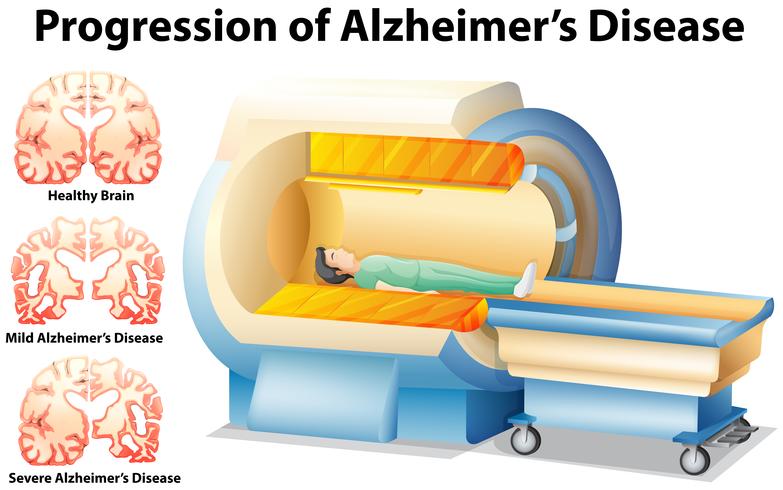 Progression de la maladie d&#39;Alzheimer vecteur