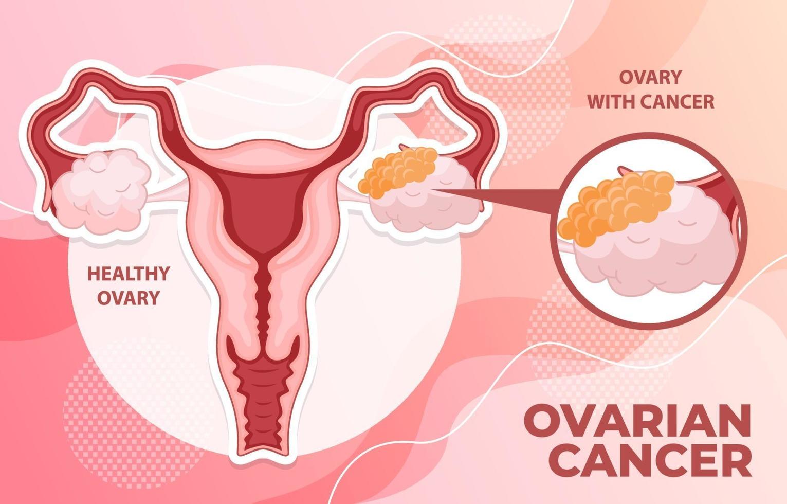 infographie sur le cancer de l'ovaire vecteur