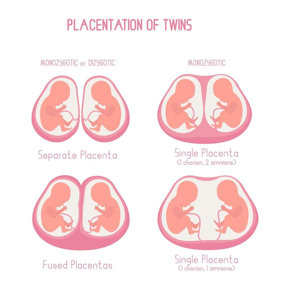 placentation des jumeaux illustration plate vecteur