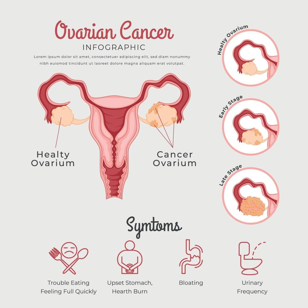 infographie sur le cancer de l'ovaire vecteur