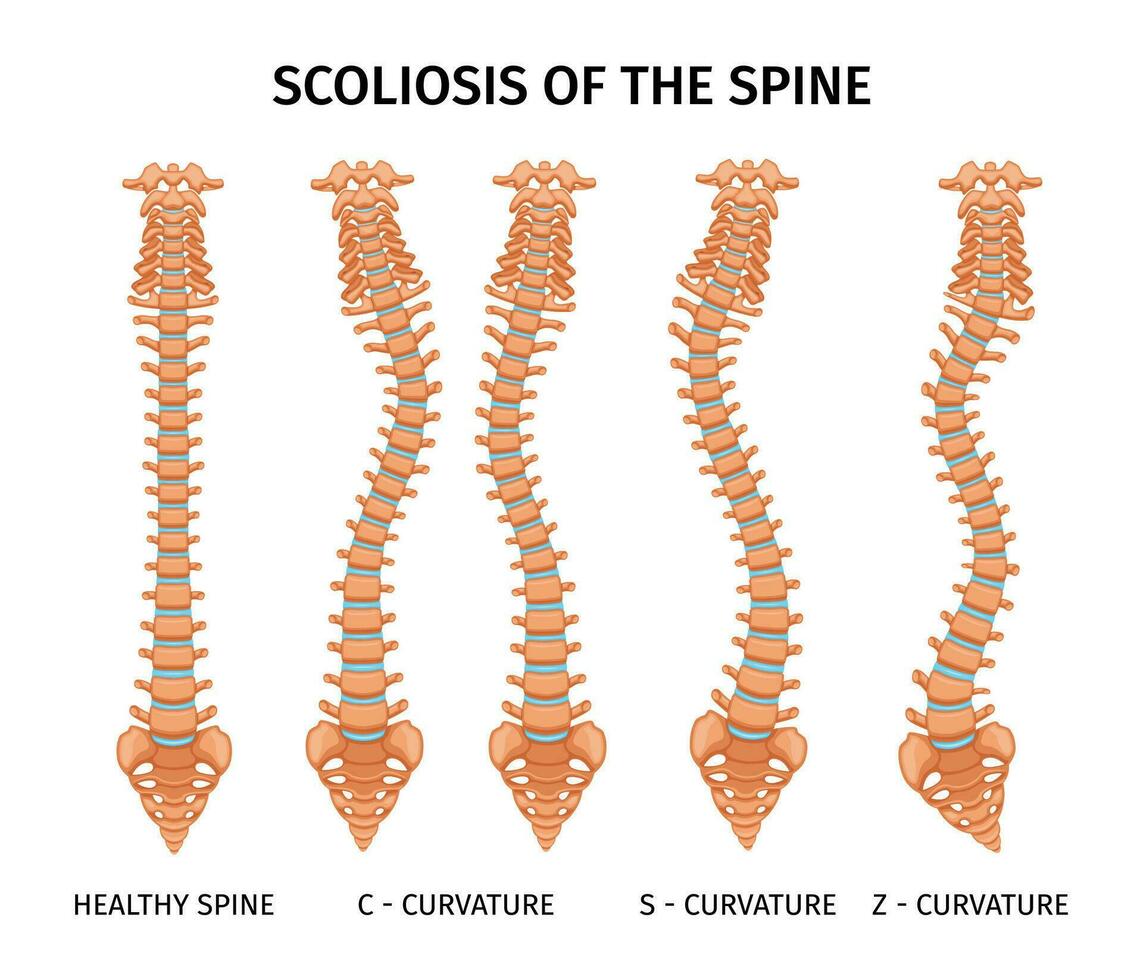 colonne vertébrale scoliose anatomie infographie vecteur