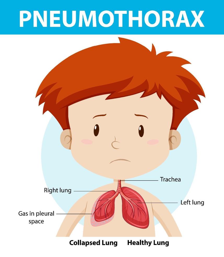 diagramme de pneumothorax de l'anatomie humaine vecteur