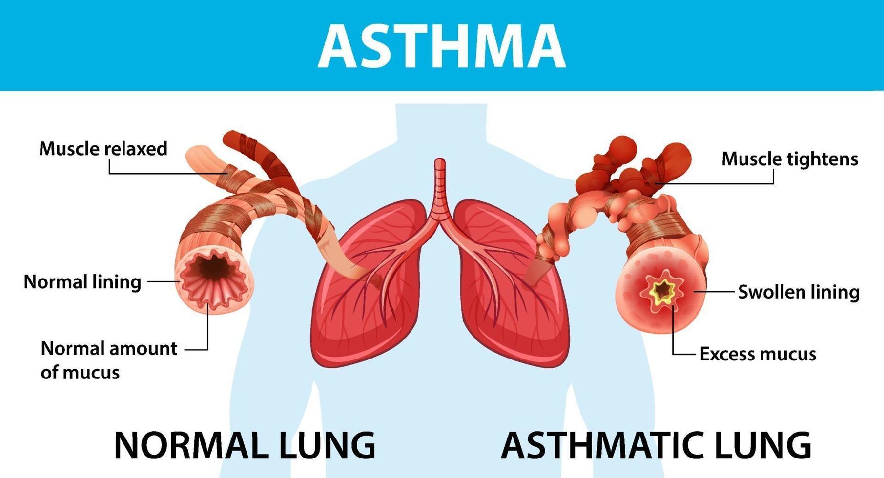 diagramme d'asthme avec poumon normal et poumon asthmatique vecteur