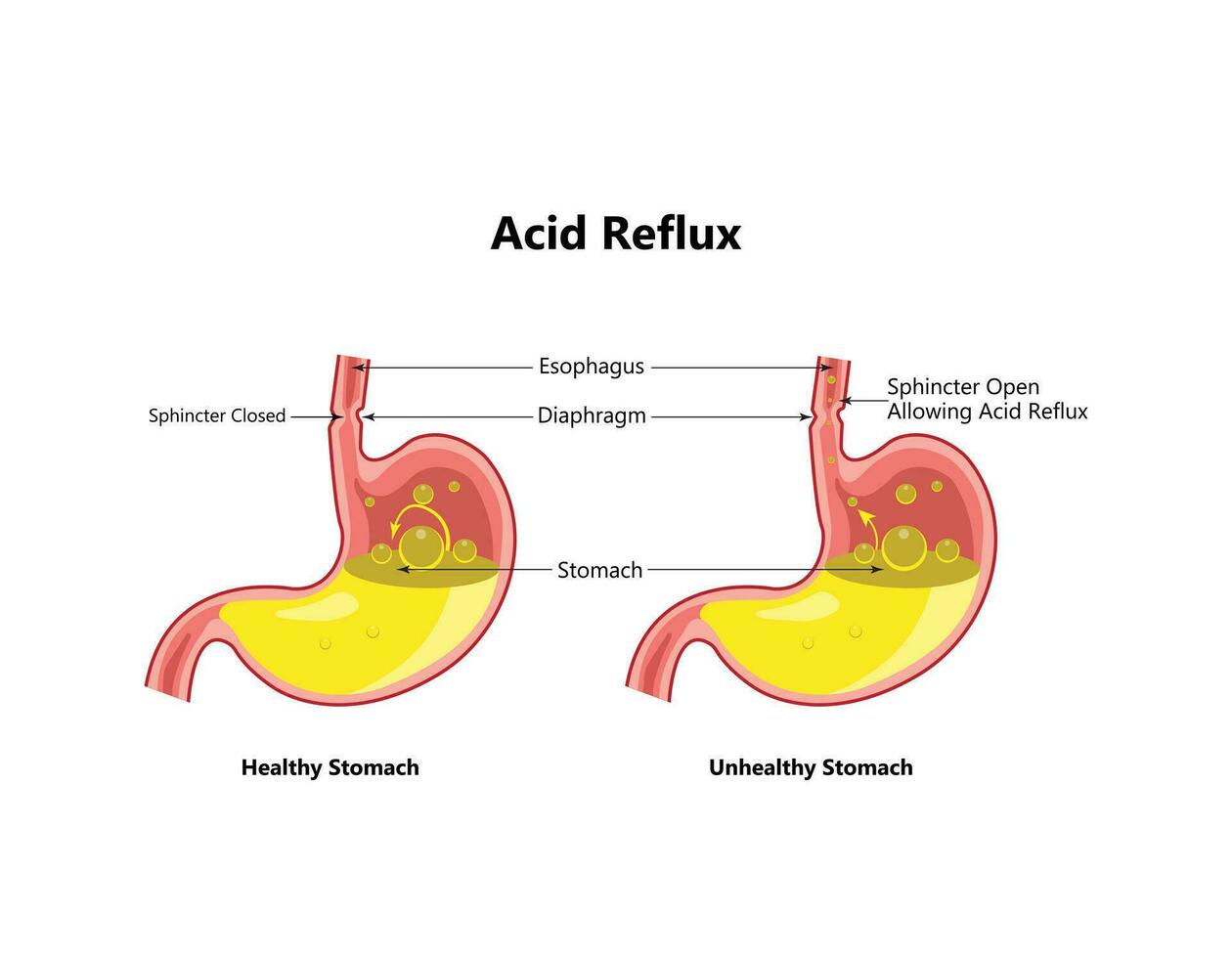 reflux ou gastro-oesophagien reflux, brûlures d'estomac. estomac maladie, estomac problème maladie concept. vecteur dessin