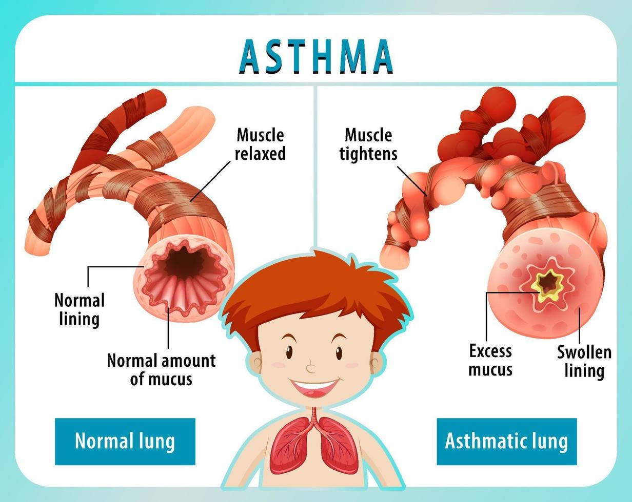 diagramme d'asthme avec poumon normal et poumon asthmatique vecteur