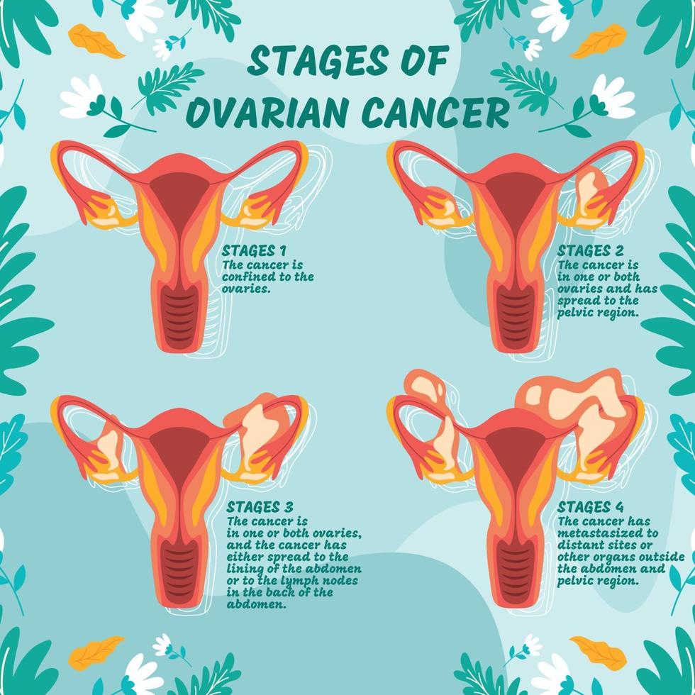 infographie sur le stade du cancer de l'ovaire vecteur