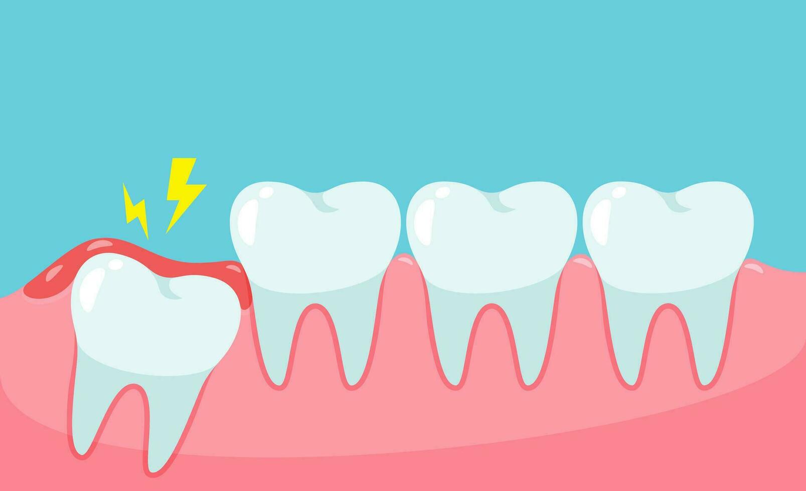 impacté sagesse dent cause douleur dans le bouche.dentaire se soucier concept vecteur