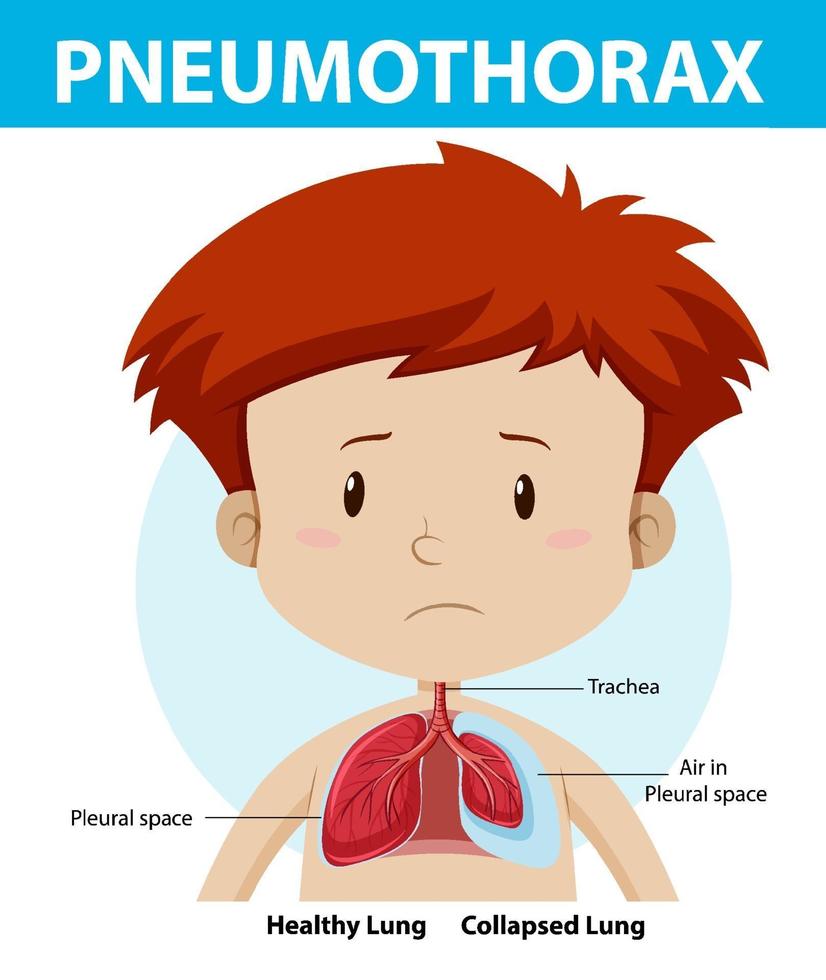 diagramme de pneumothorax de l'anatomie humaine vecteur