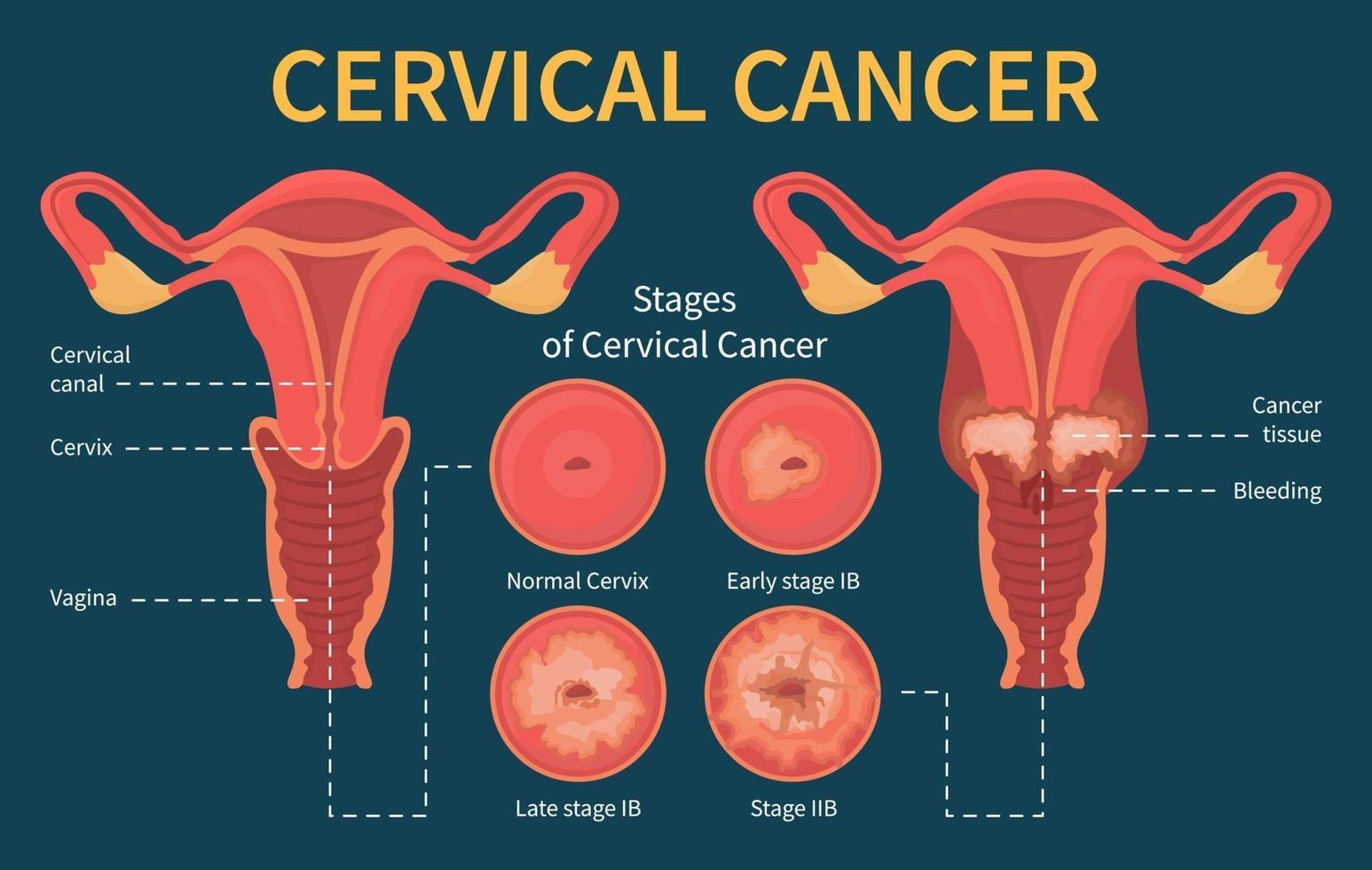 stades du schéma d'infographie sur le cancer du col de l'utérus chez la femme vecteur