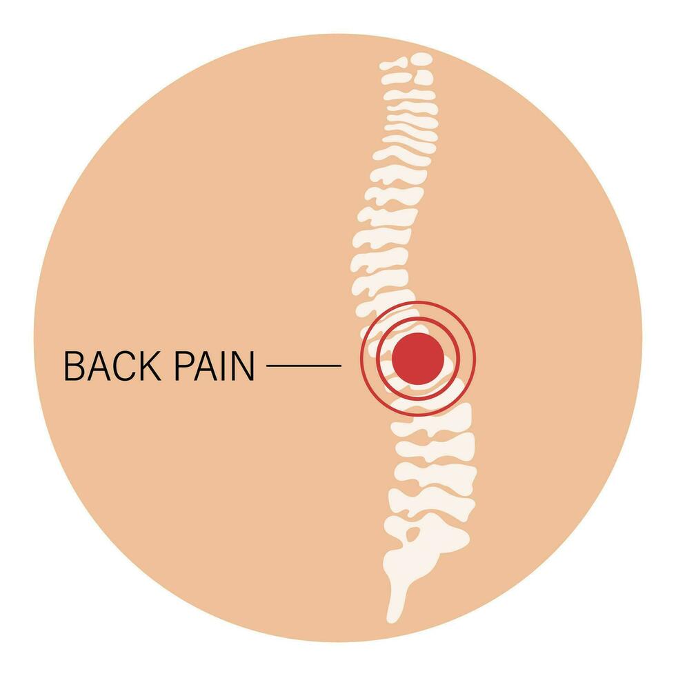 retour douleur, spinal douleur, l'arthrose, rhumatoïde arthrite. anatomie de Humain os. médicament. illustration, vecteur