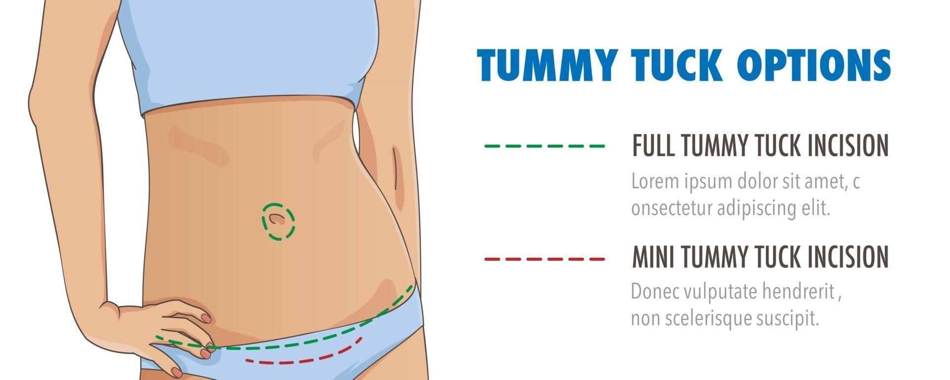 abdominoplastie, bannière infographique d'abdominoplastie vecteur