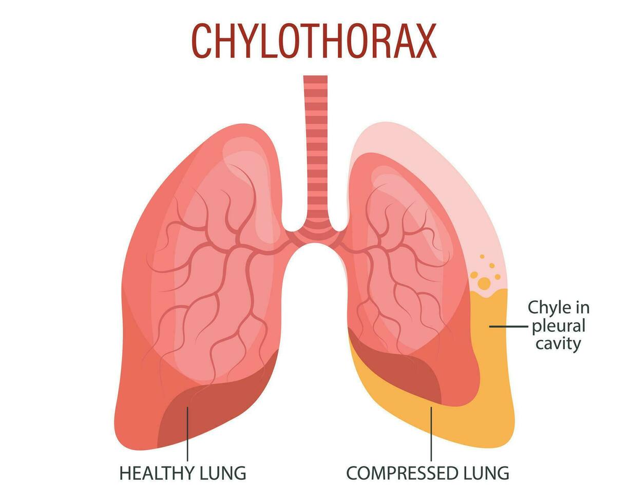 le chylothorax, poumon maladies. soins de santé. médical infographie bannière, illustration, vecteur