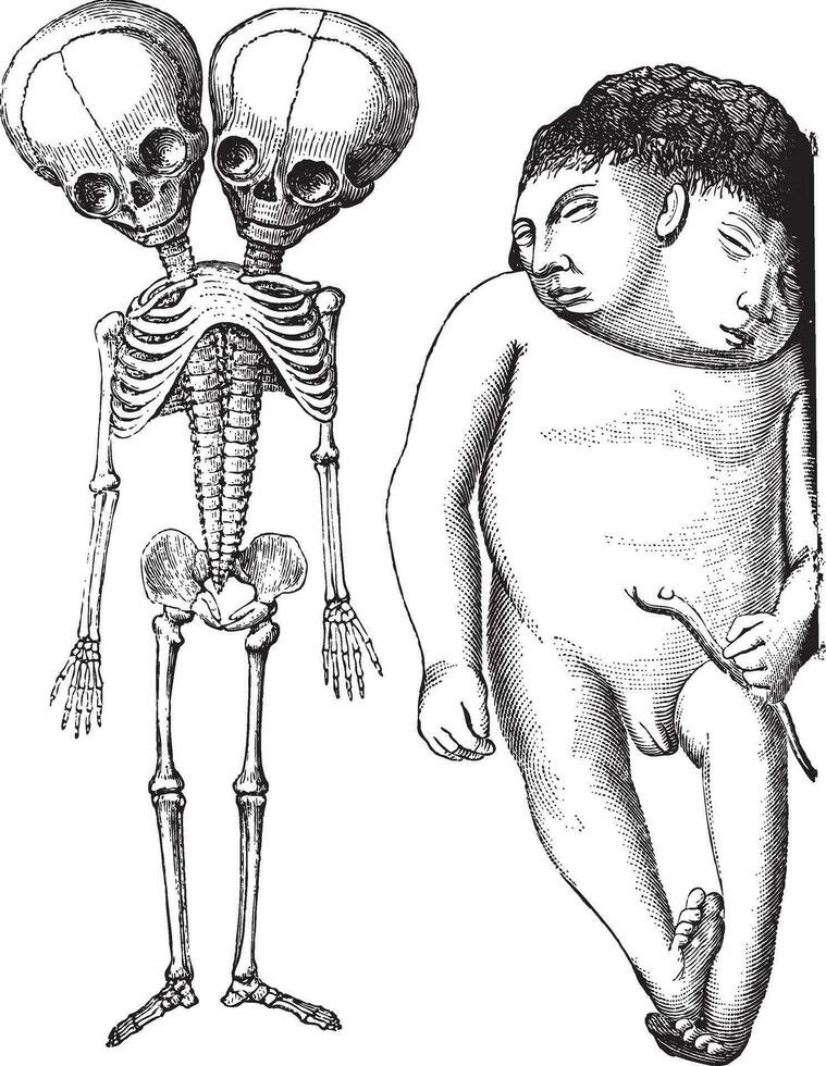 figue. 174. squelette de deux têtes monstre dérodyme. musée dupuytren, figue. 175. iniodyne deux têtes monstre, ancien gravure. vecteur