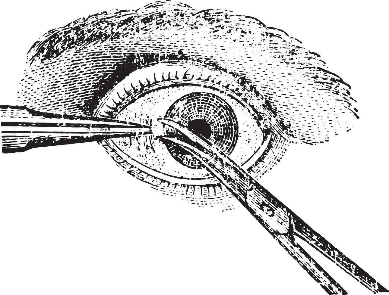 strabisme chirurgie, ancien gravure. vecteur