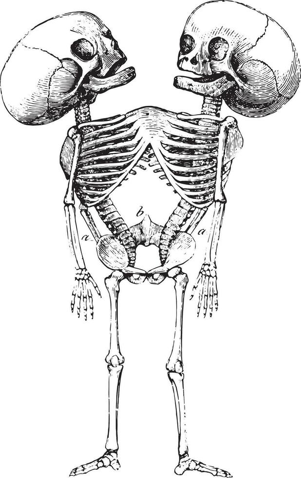 monstre sternopage, ancien gravure. vecteur