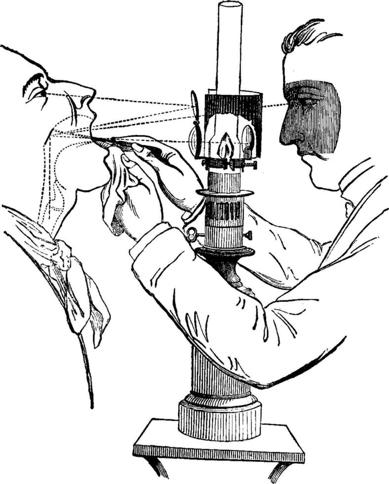 laryngoscope, ancien gravure vecteur