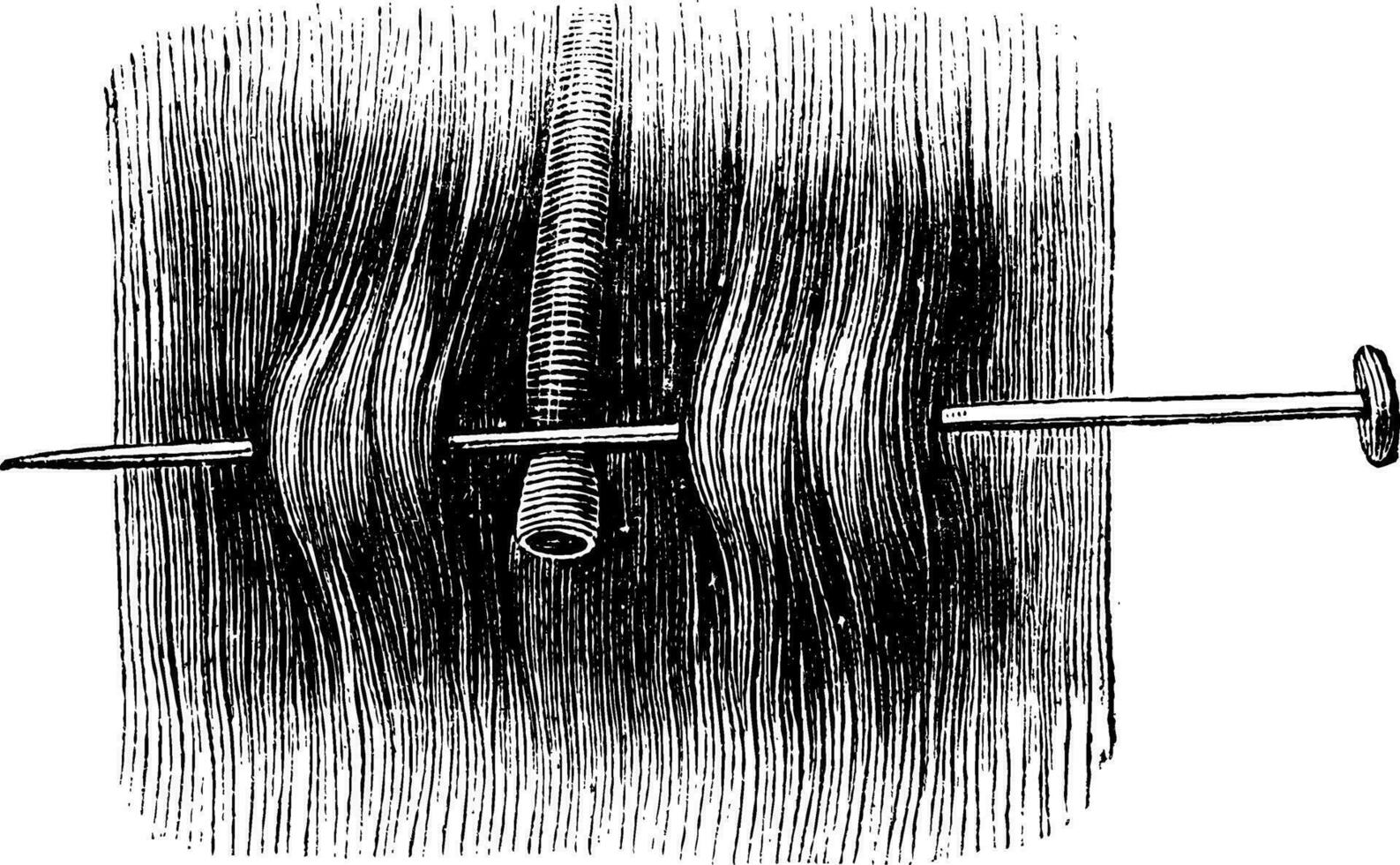 acupression avec une Célibataire aiguille, ancien gravure. vecteur