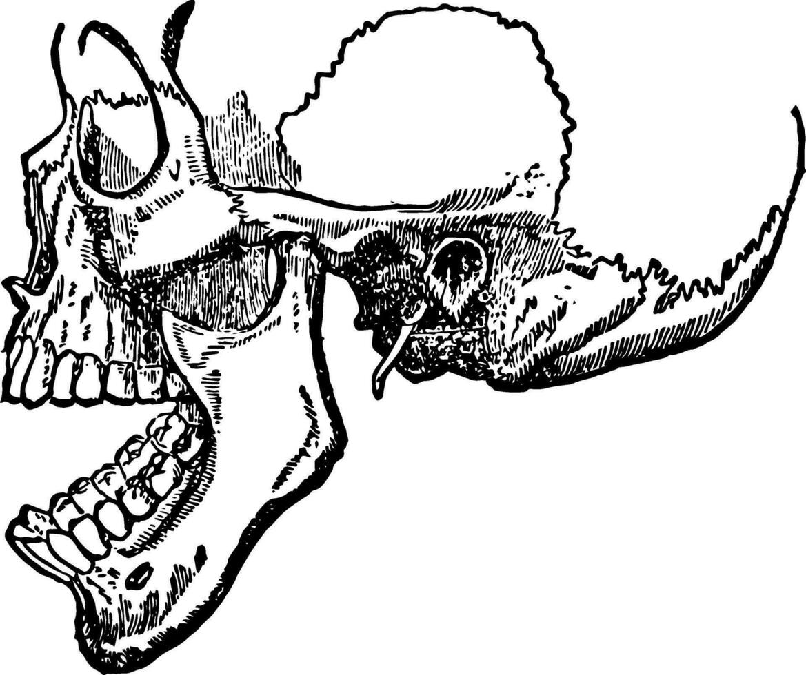 dislocation de le inférieur mâchoire, ancien illustration. vecteur