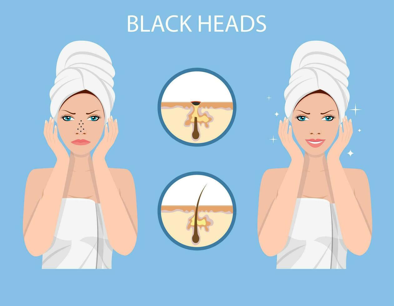 une femme porte une serviette sur sa tête avec nez paquet, points noirs sur nez. spa beauté et santé concept. vecteur illustration dans plat style