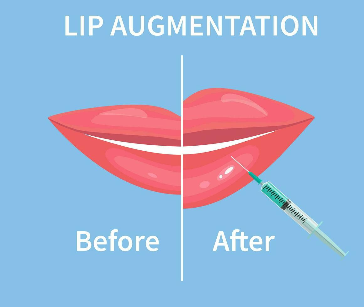 lèvre augmentation. avant et après lèvre remplissage injections. hyaluronique acide injections. vecteur illustration dans plat style