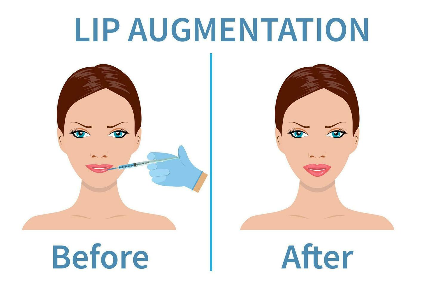 lèvre augmentation. avant et après lèvre remplissage injections. hyaluronique acide injections. vecteur illustration dans plat style