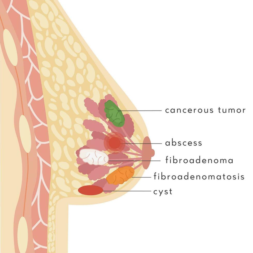 médical infographie traverser section de femelle Sein avec abcès. information carte avec pus rempli grumeau. anatomie de femme poitrine avec infection. inflammation de mammaire glande. douleur. vecteur illustration.