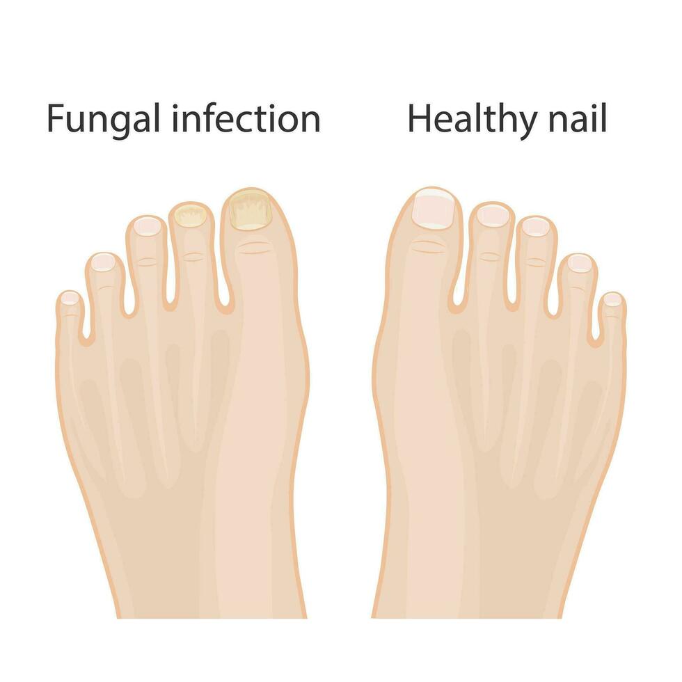 clou maladies. onychomycose, causes de fongique clou infection. médical infographie conception vecteur