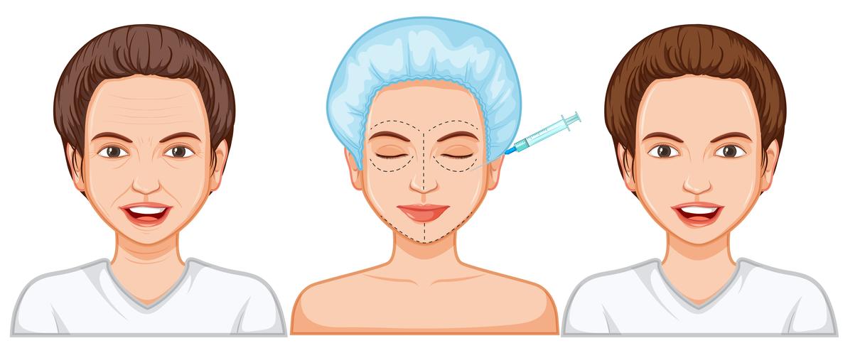 Comparaison de l&#39;injection de botox chez la femme vecteur