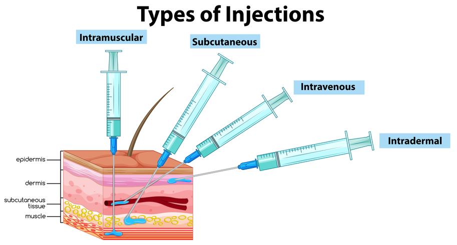 Types d&#39;injections sur fond blanc vecteur