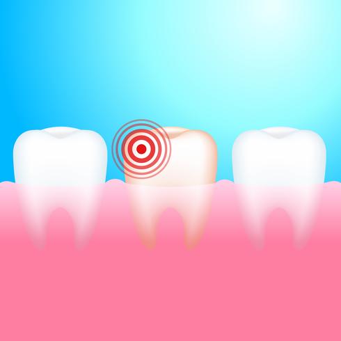 Mal aux dents. Une dent avec des caries dentaires et des douleurs. Illustration réaliste de vecteur
