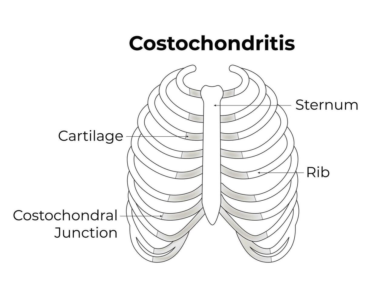 costochondrite science conception vecteur illustration