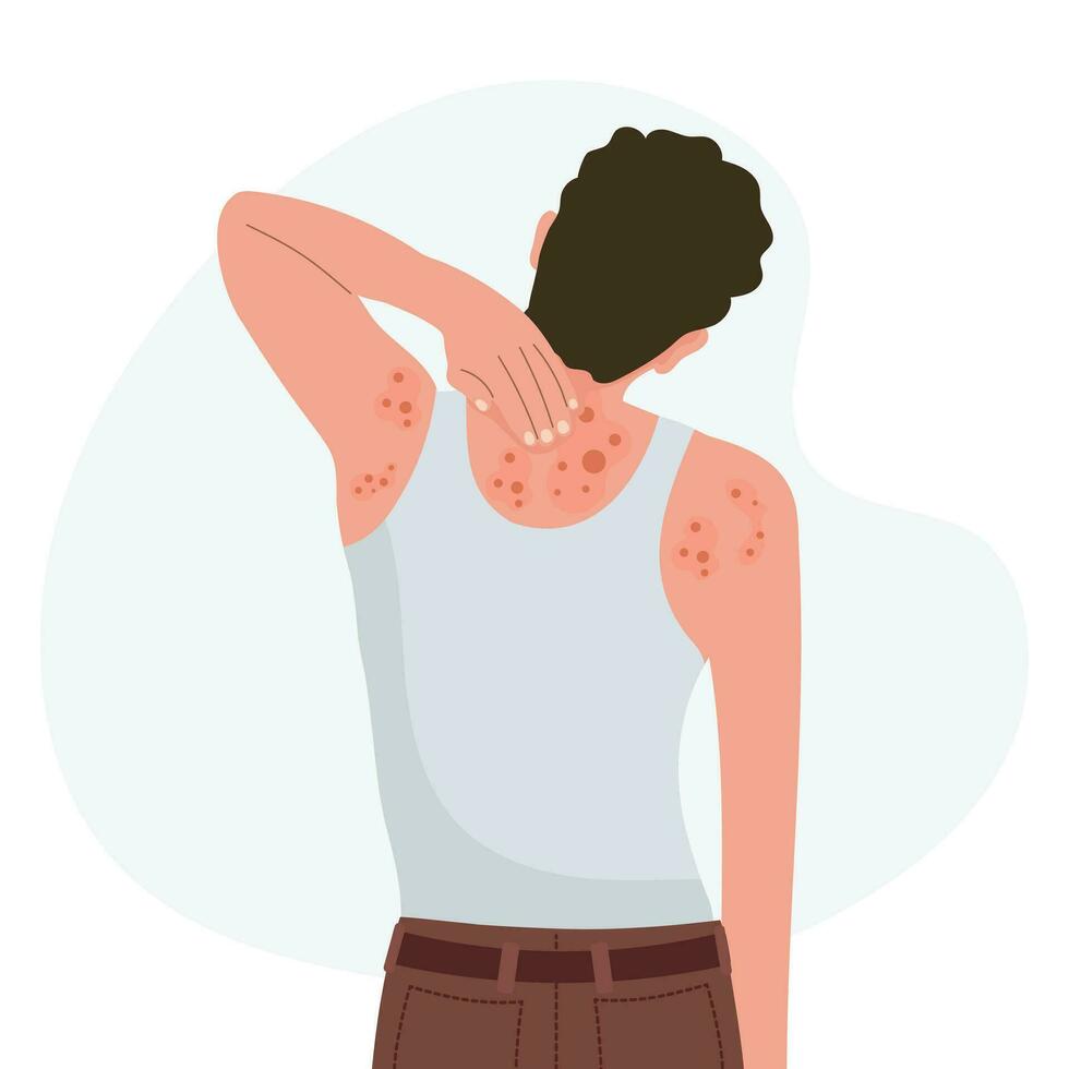 allergique démangeaison, peau inflammation, rougeur et irritation. un sujet dermatite, eczéma, psoriasis. soins de santé et médicament. vecteur
