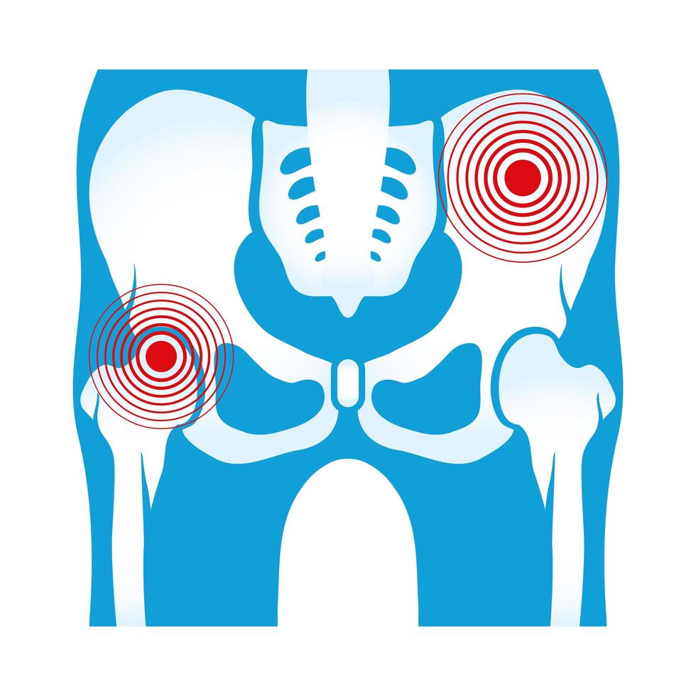 douleurs rhumatologiques des hanches vecteur