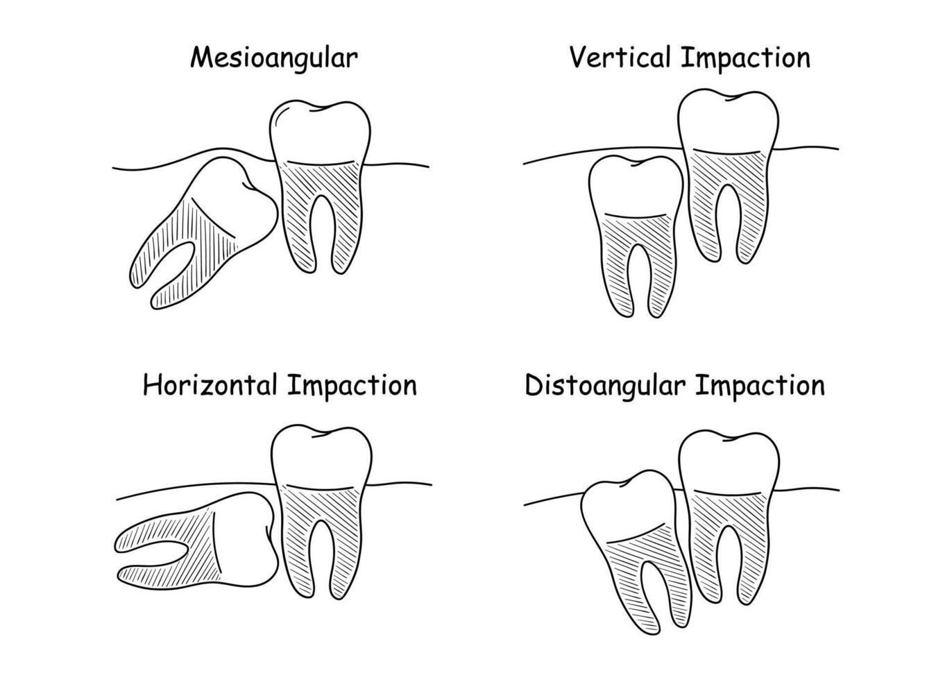 dentaire anatomie ensemble, Incorrect les dents croissance, ensemble de vecteur des illustrations dans griffonnage style