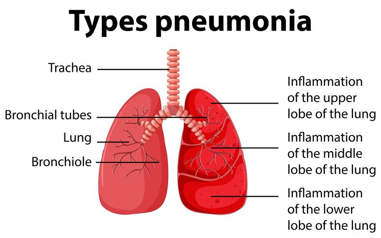 Schéma montrant les types de pneumonie vecteur