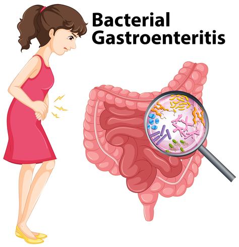 Diagramme montrant la gastro-entérite bactérienne chez l&#39;homme vecteur