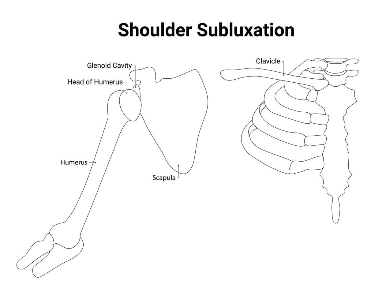 épaule subluxation science conception vecteur illustration diagramme