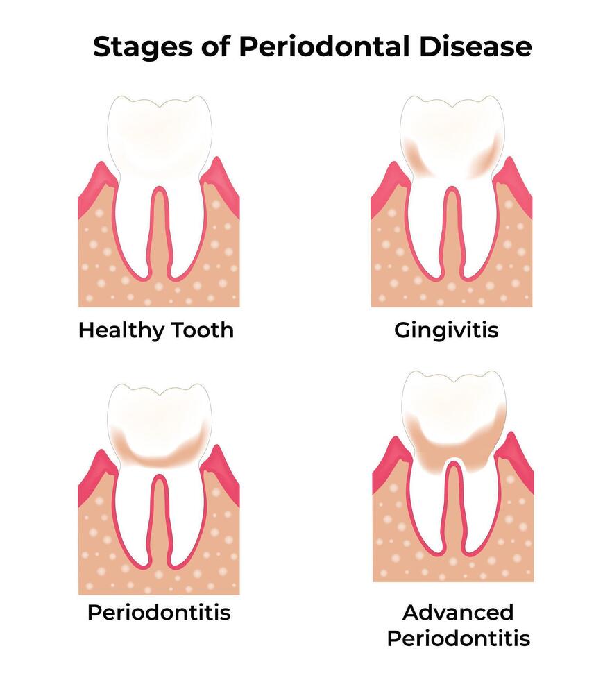 étapes de parodontal maladie science conception vecteur illustration diagramme