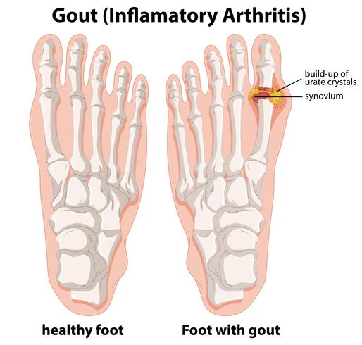 Explication schématique de la goutte dans le pied humain vecteur