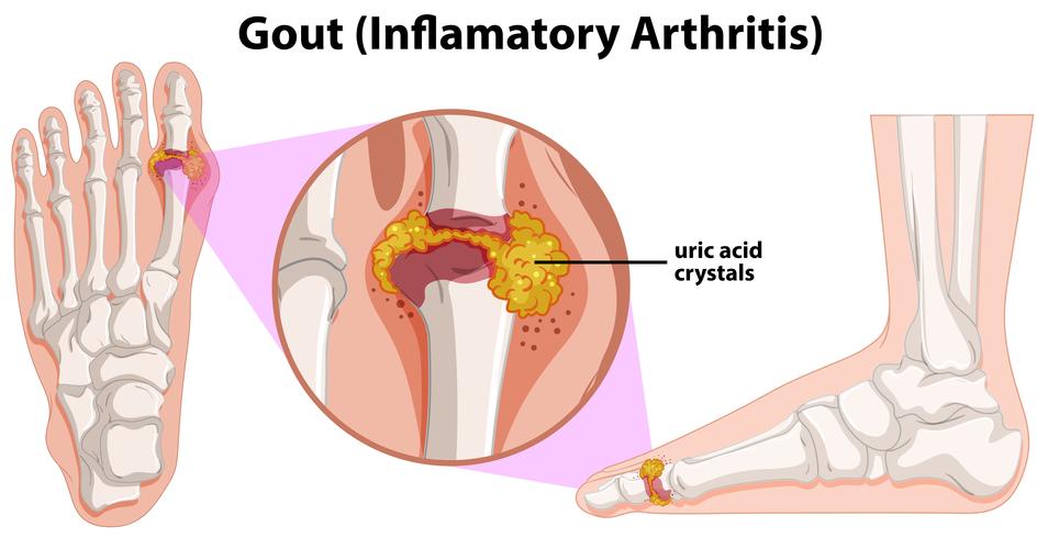 Une anatomie humaine de la goutte vecteur