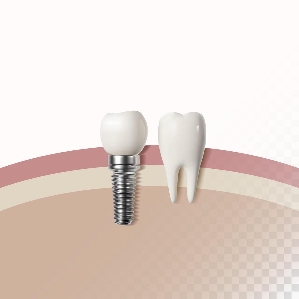 blanc dent implant implant couper, en bonne santé dent ou dentaire chirurgie. vecteur